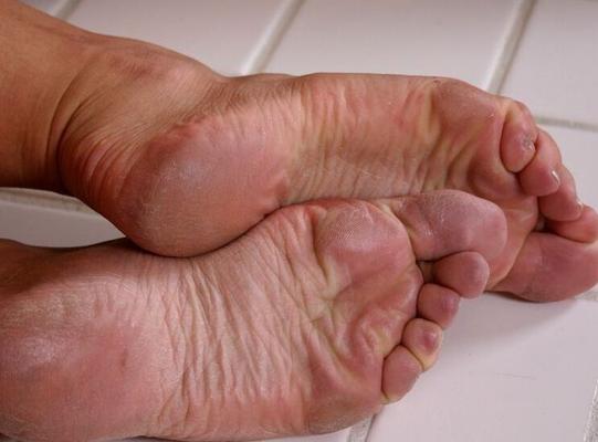 Hot Feet and Soles