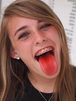 Braces